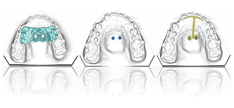 Dentaurum vermittelt Wissen zum Digitalen Workflow mit OnyxCeph3TM